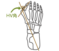 HV角